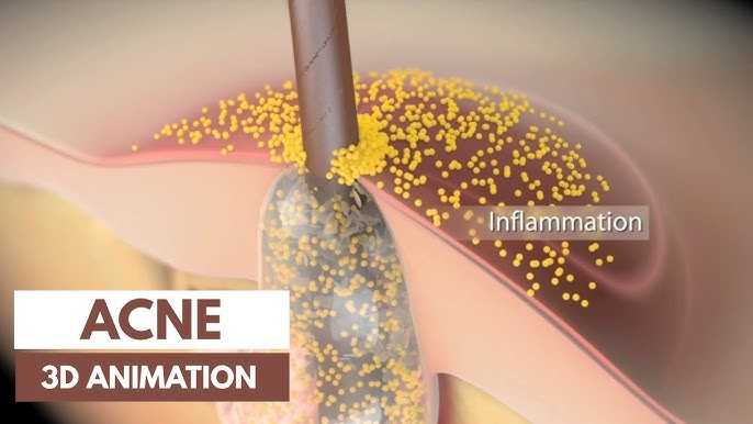 Acne: Types, Causes, Treatment and Prevention